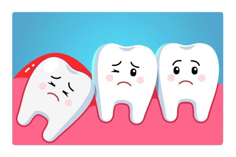 Wisdom Teeth Removed Treatment in Brighton