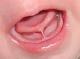 tongue tie release treatment in brighton