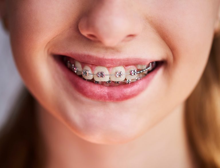 How to Keep Your Child's Braces—and Room—Clean