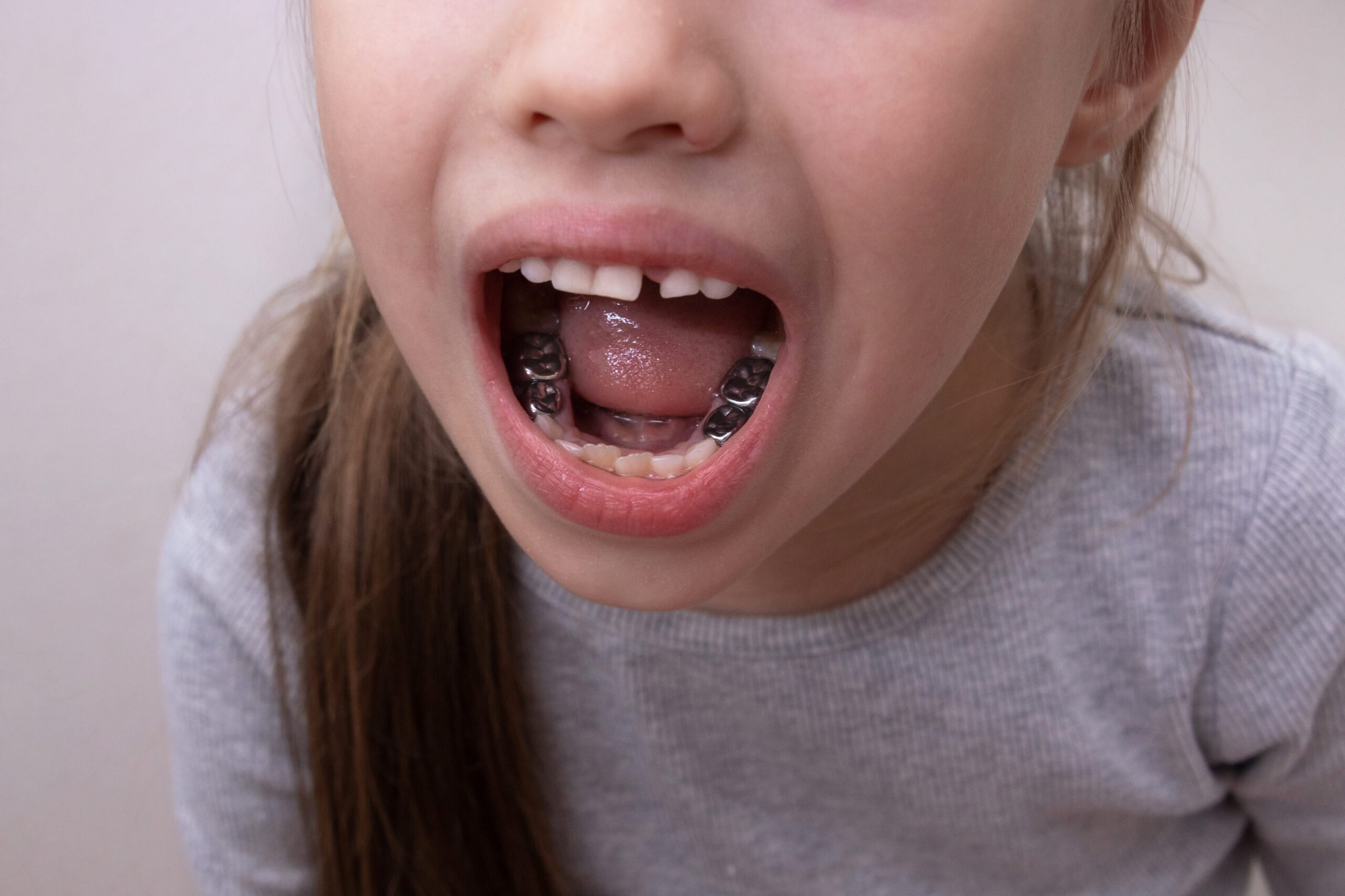 When Is a Crown Better Than a Filling for a Child’s Tooth?
